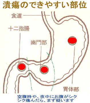 胃潰瘍と風邪