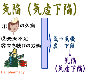 気陥（気虚下陥）