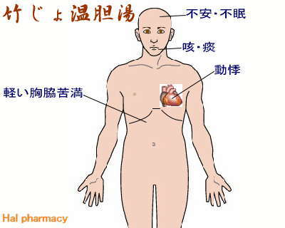 竹筎温胆湯